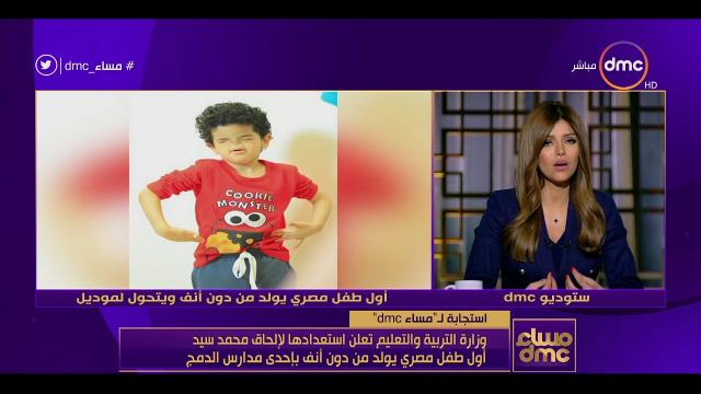 أول طفل مصري يولد دون أنف