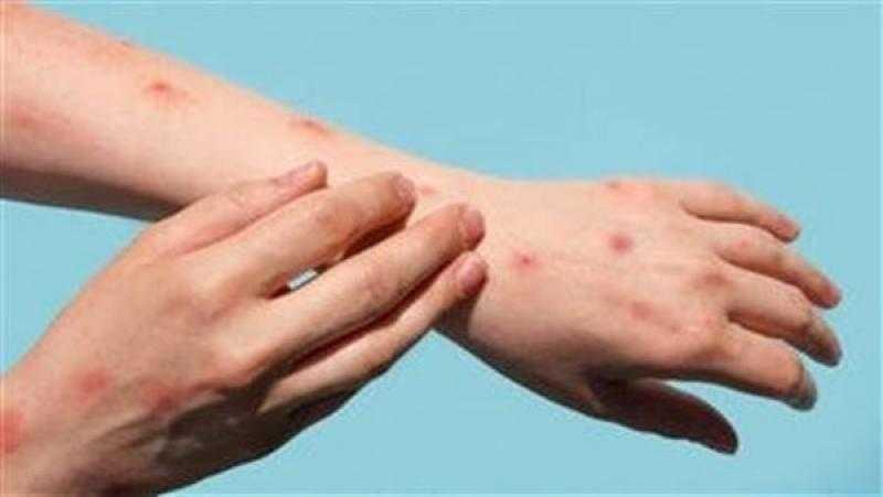 ماليزيا تسجل أول إصابة بجدري القرود خلال عام 2024